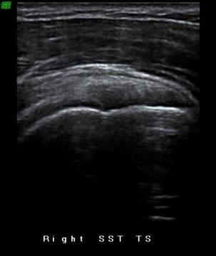 Normal supraspinatus tendon