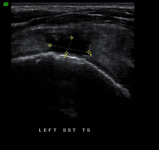 Partial tear of the supraspinatus tendon - Harmonic Medical Sonography ...